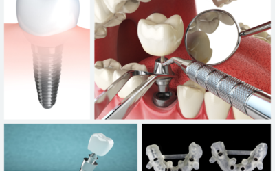 Implantologia Computer Guidata: La Frontiera Avanzata degli Impianti Dentali