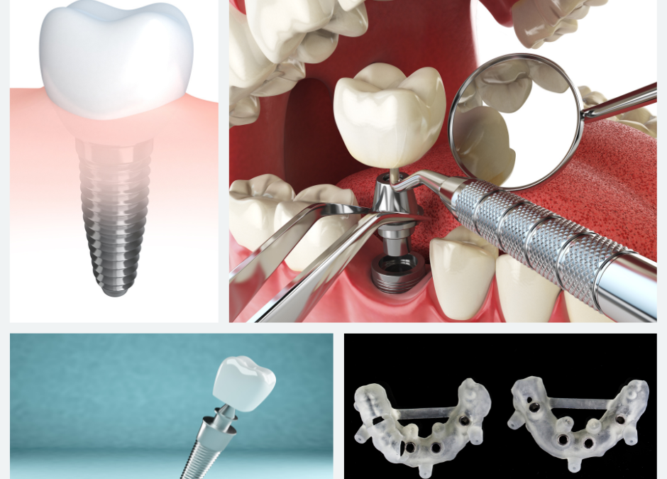 Implantologia Computer Guidata: La Frontiera Avanzata degli Impianti Dentali