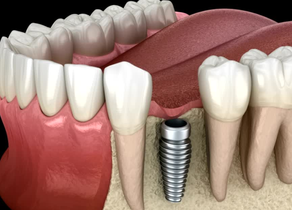 Tutto Quello che Devi Sapere Sugli Impianti Dentali